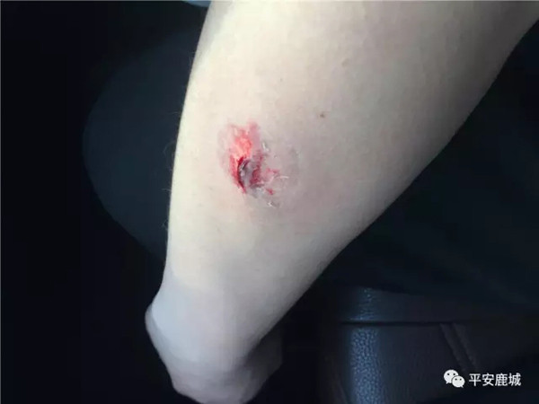 贵州一毒贩拒捕咬伤民警,押解途中称自己患有艾滋病